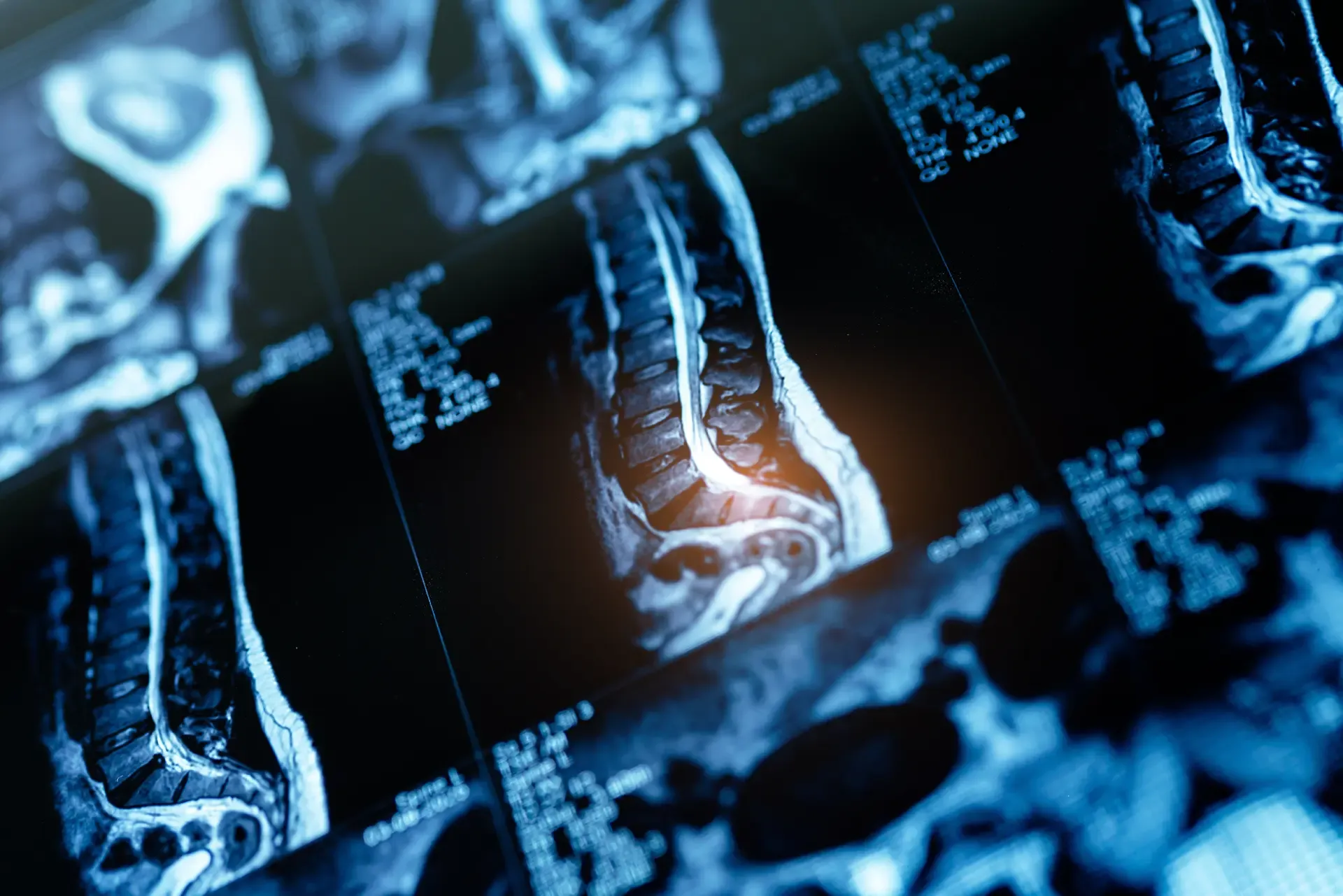 Price Spinal Cord Injuries Car Crashes
