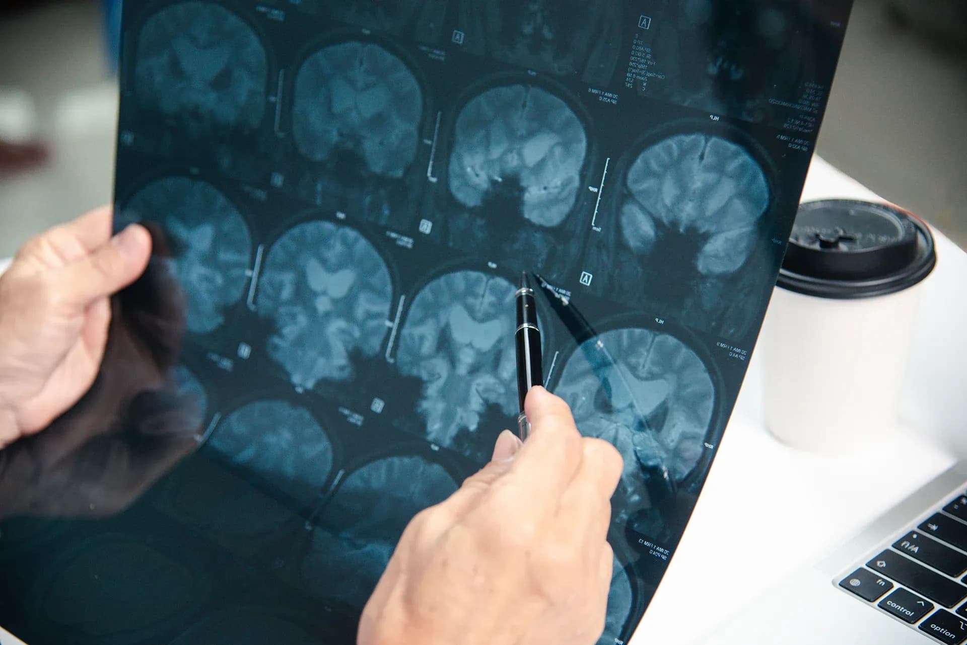 Síntomas habituales de una lesión cerebral traumática Síntomas habituales de una lesión cerebral traumática