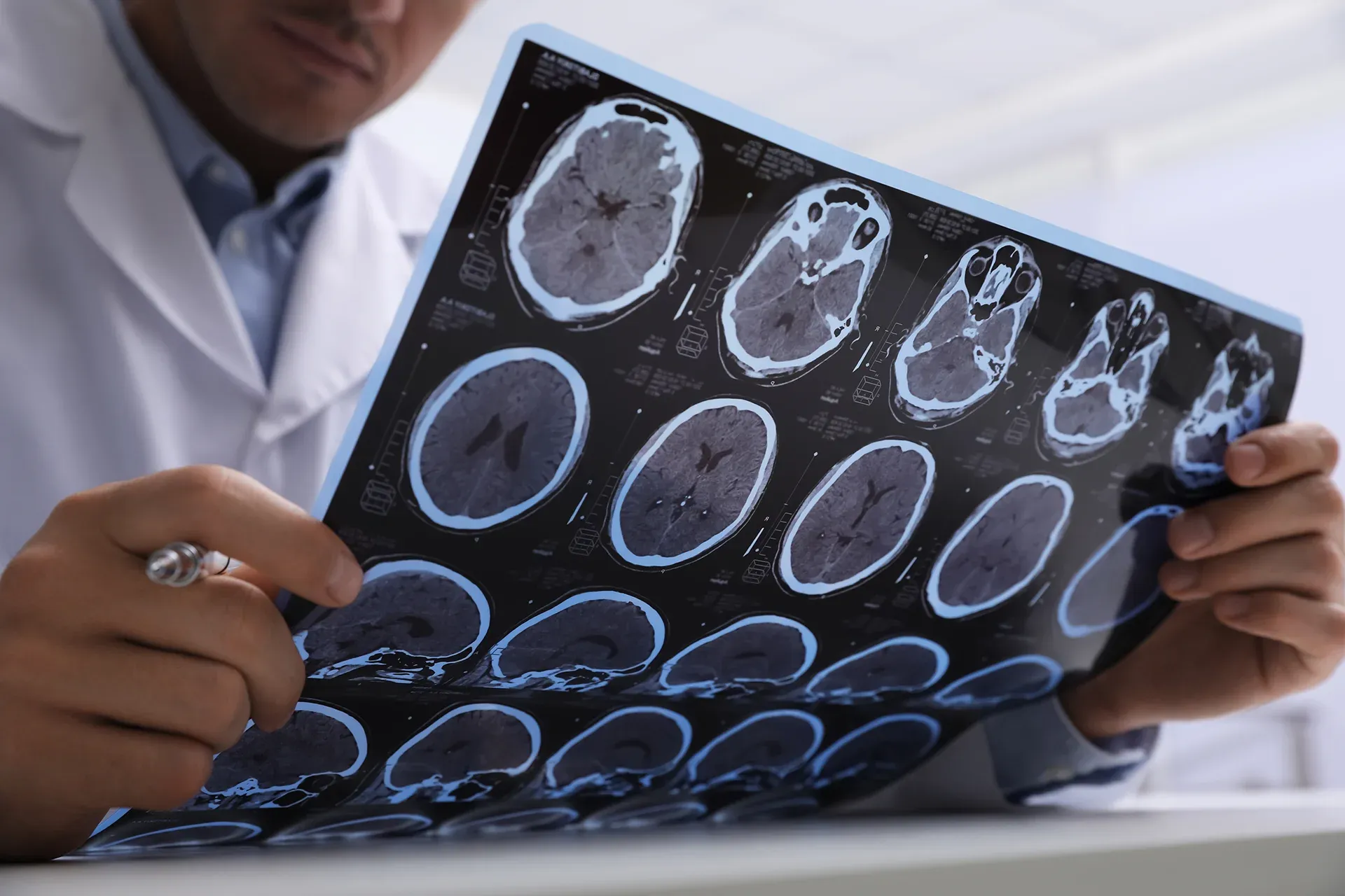 Posibles efectos de una conmoción cerebral provocada por un accidente de tráfico Posibles efectos de una conmoción cerebral provocada por un accidente de tráfico