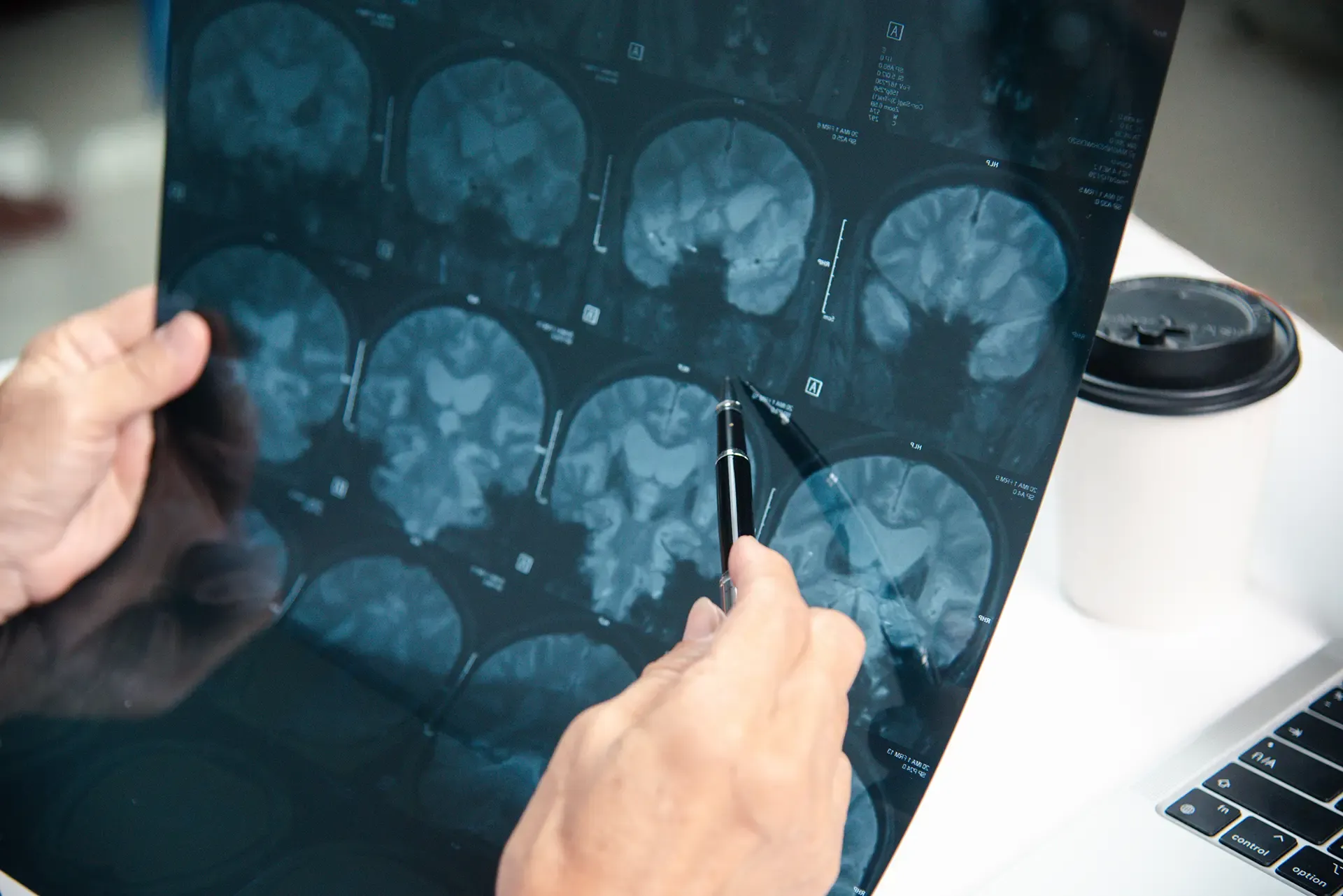 ¿Qué tipos de indemnizaciones son habituales en los casos de lesión cerebral traumática? ¿Qué tipos de indemnizaciones son habituales en los casos de lesión cerebral traumática?