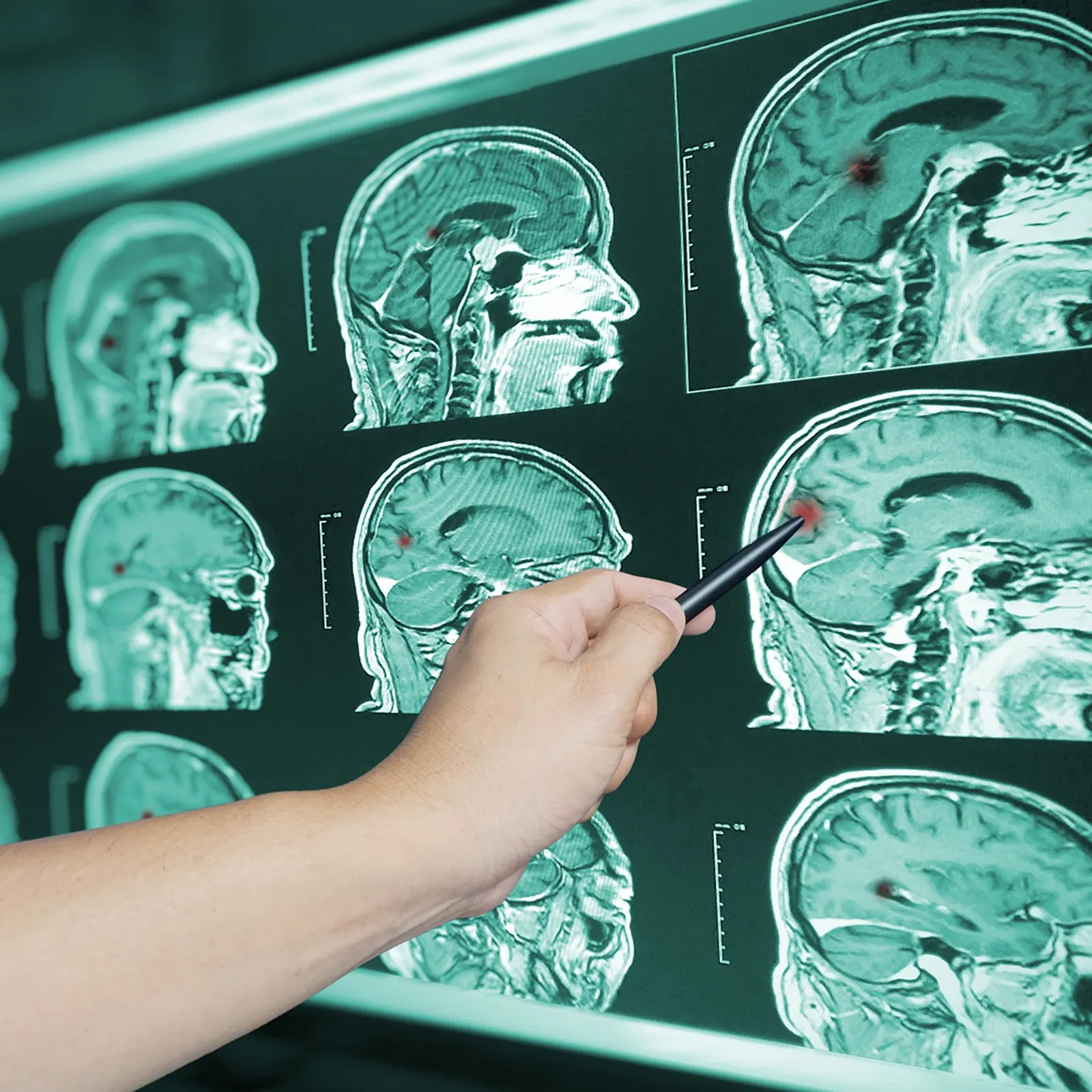 área-de-práctica-lesiones-personales-lesiones-graves-lesión-cerebral-traumática-02 área-de-práctica-lesiones-personales-lesiones-graves-lesión-cerebral-traumática-02